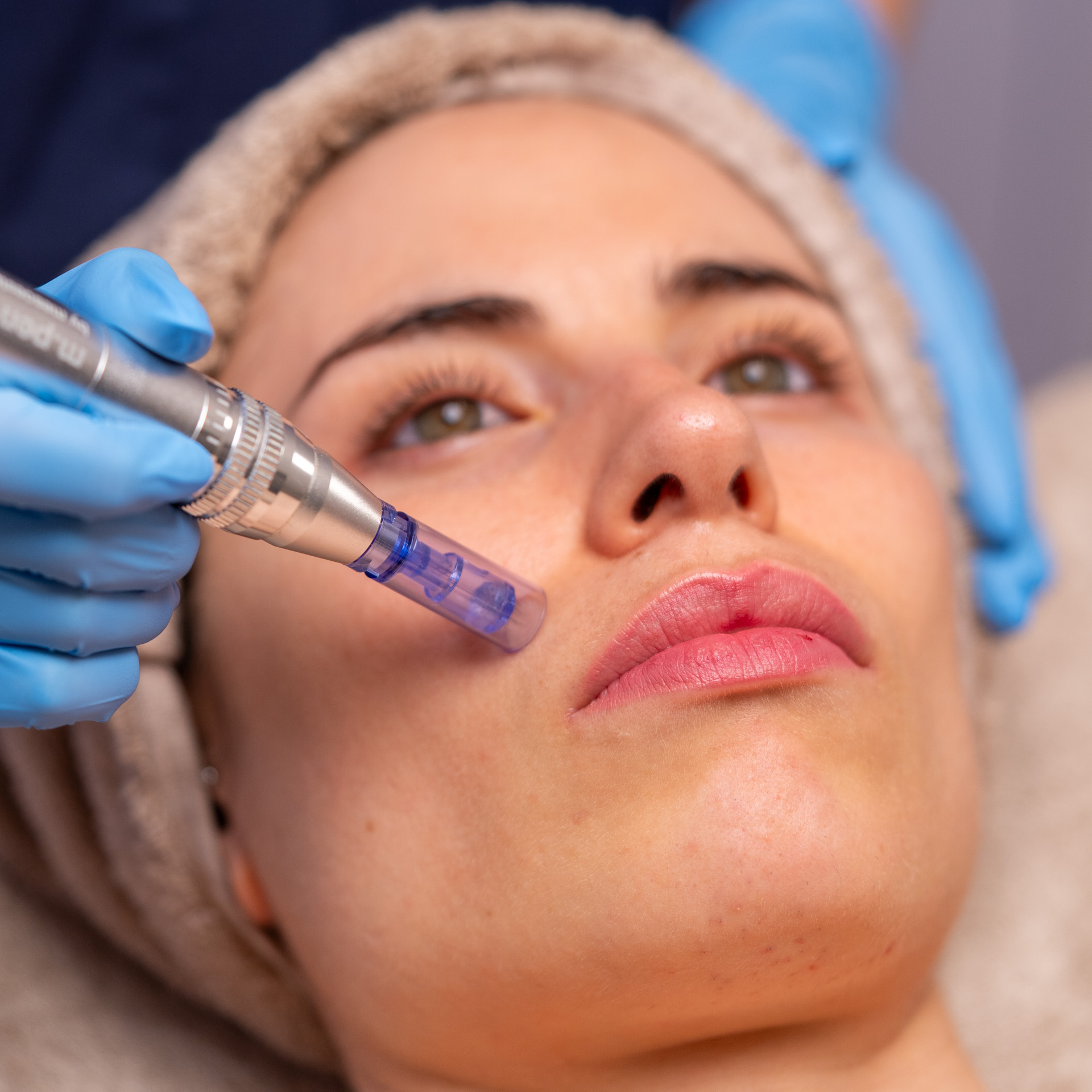 Microneedling